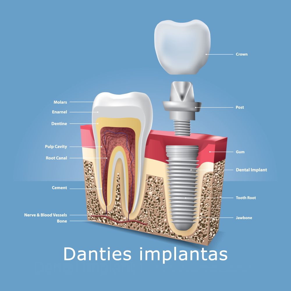 Danties implantas